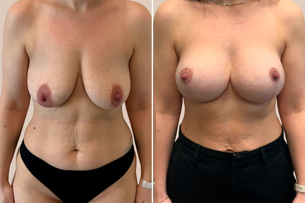BFO + stort brystløft Før og efter
