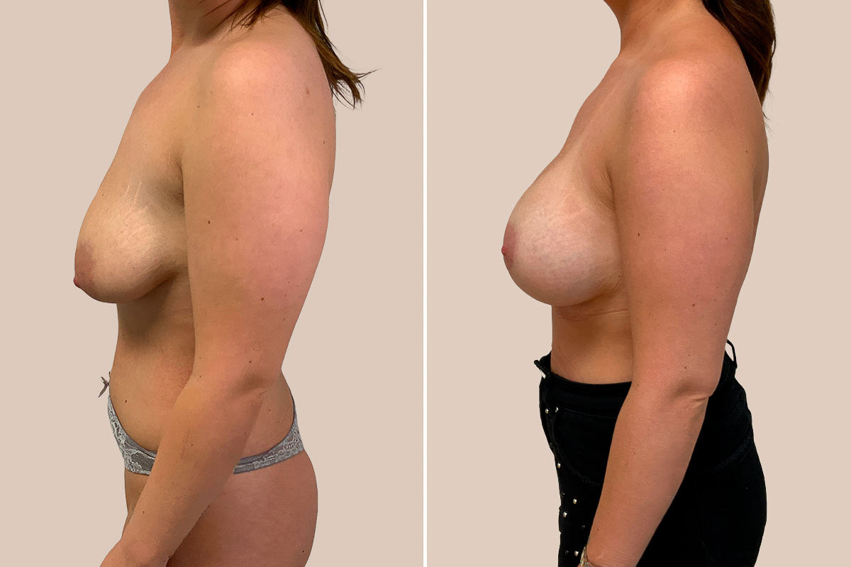 BFO + stort brystløft Før og efter