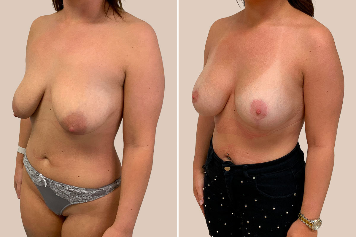 BFO + stort brystløft Før og efter