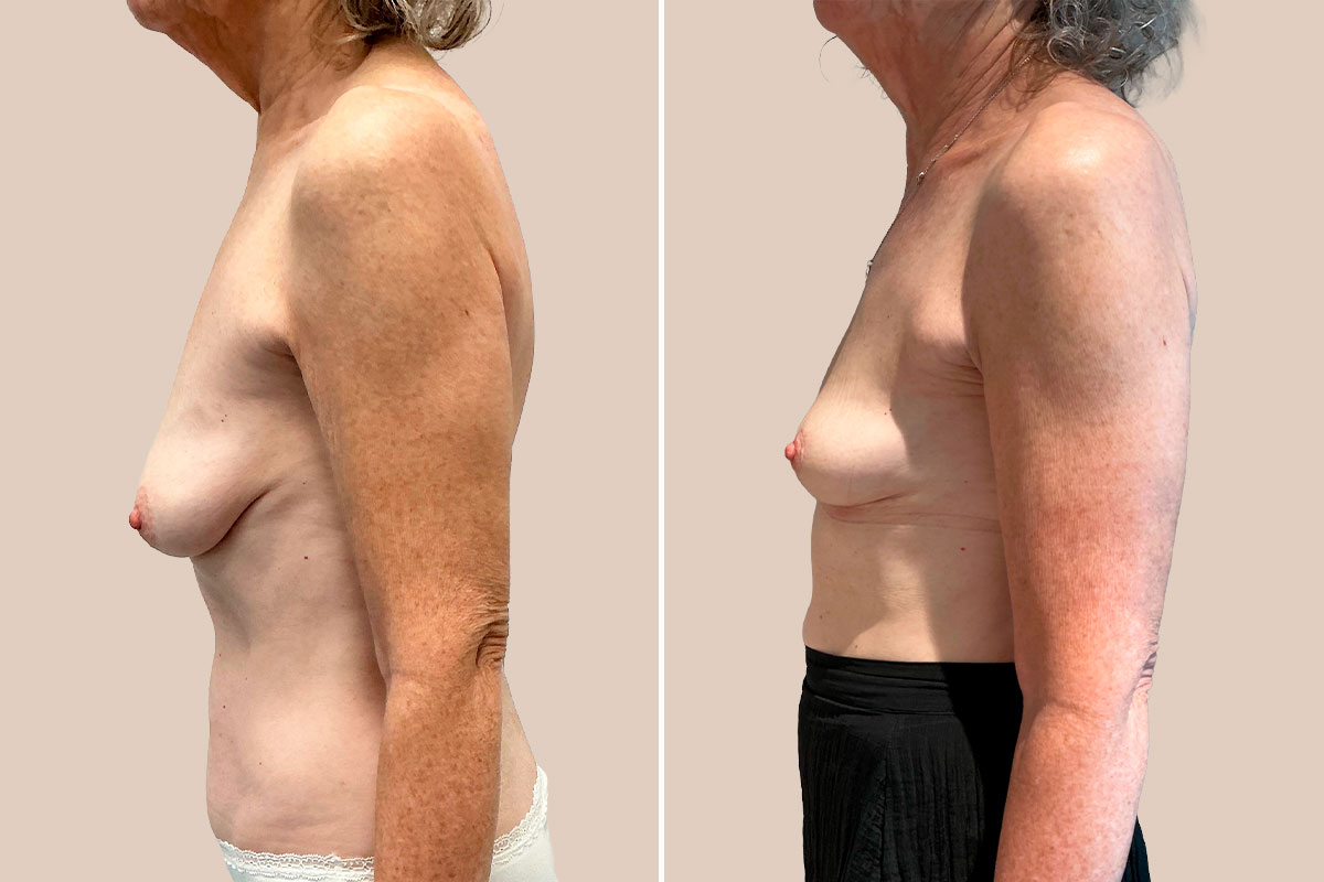 Stort brystløft før og efter