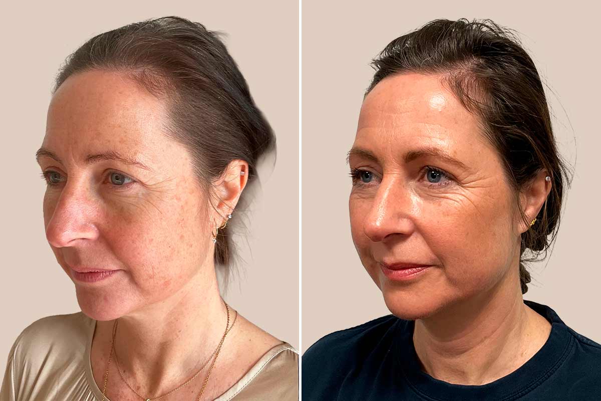 Laserbehandling før efter