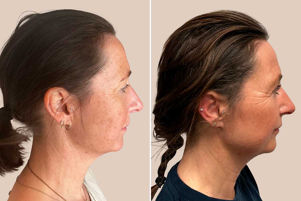 Laserbehandling før efter