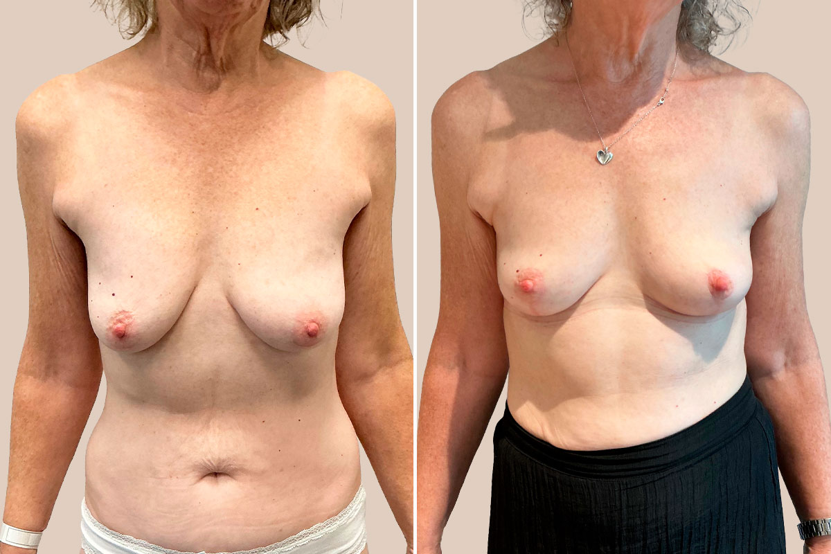 Stort brystløft før og efter