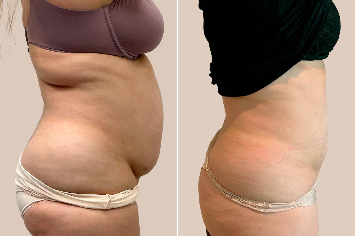 Fedtsugning før og efter
