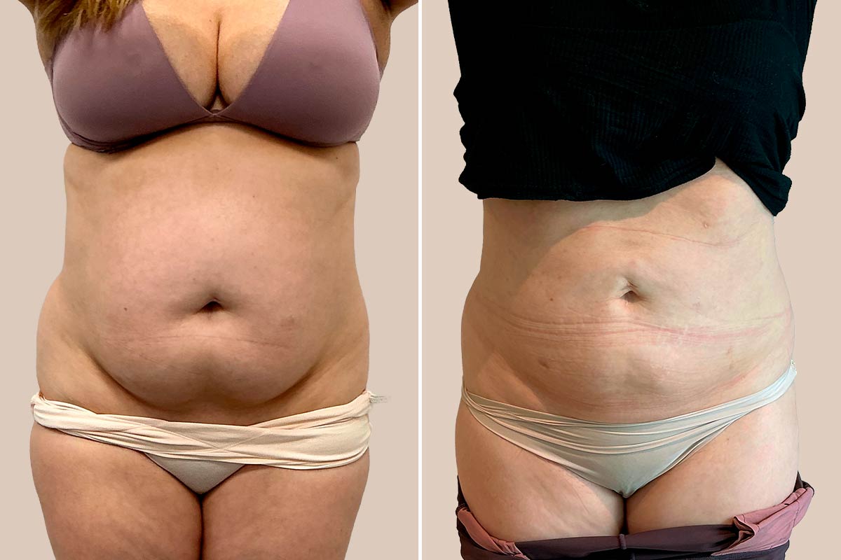 Fedtsugning før og efter