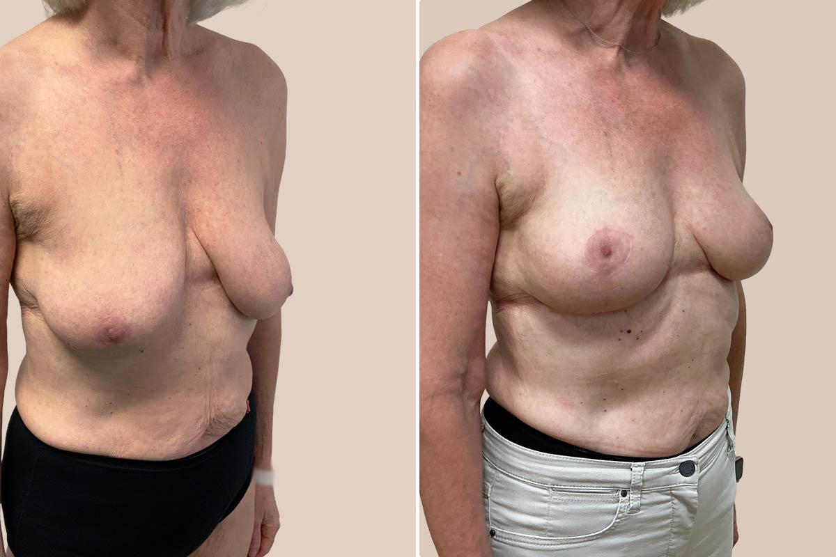 Stort brystløft før og efter