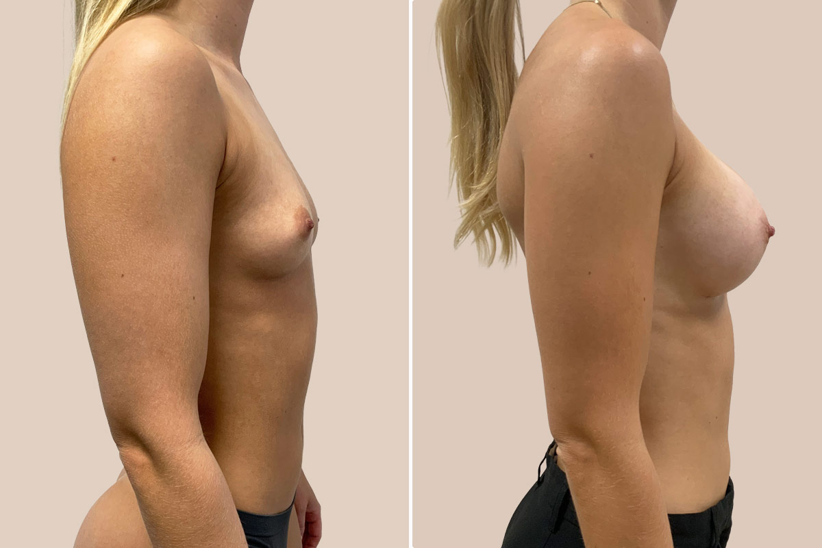 Brystforstørrelse før og efter