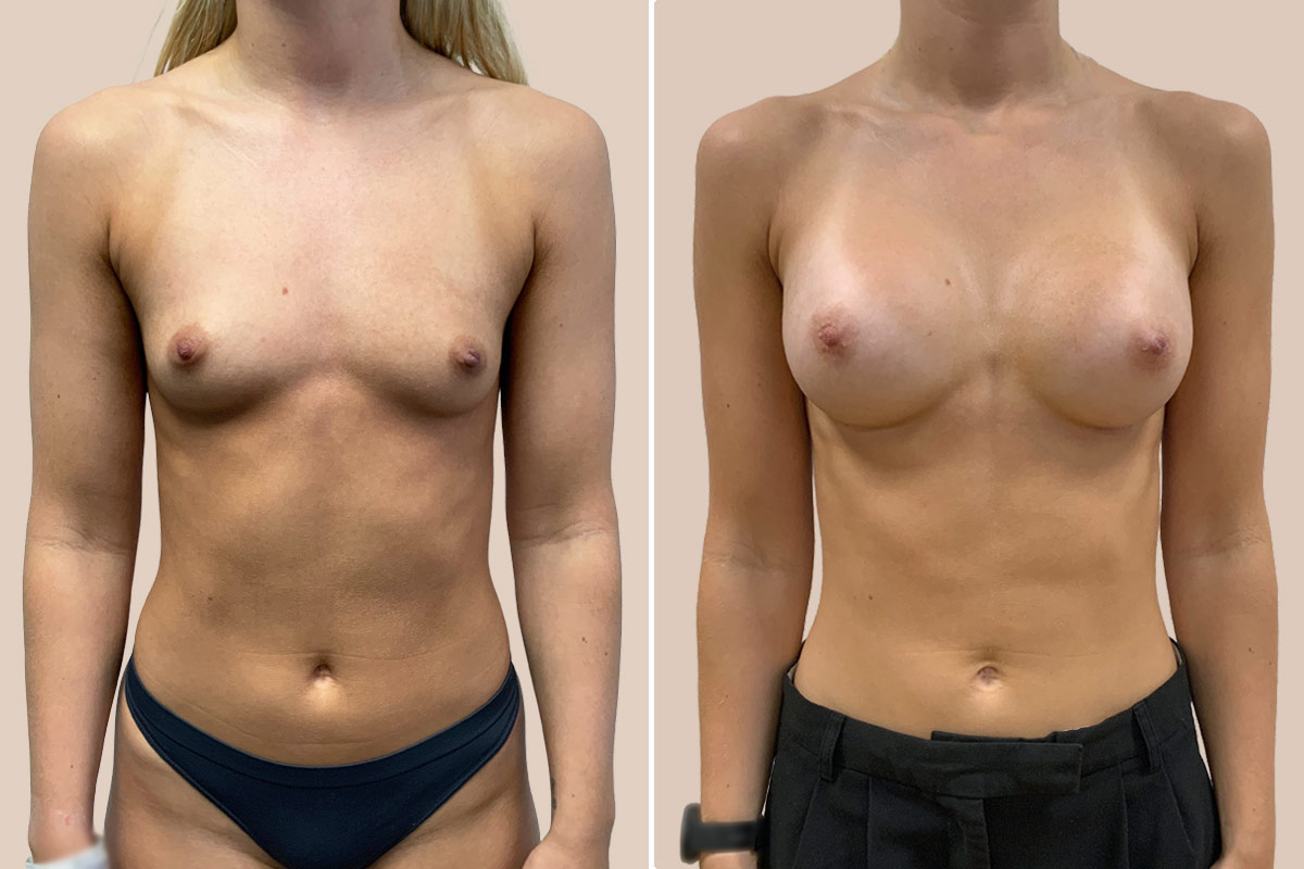 Brystforstørrelse før og efter