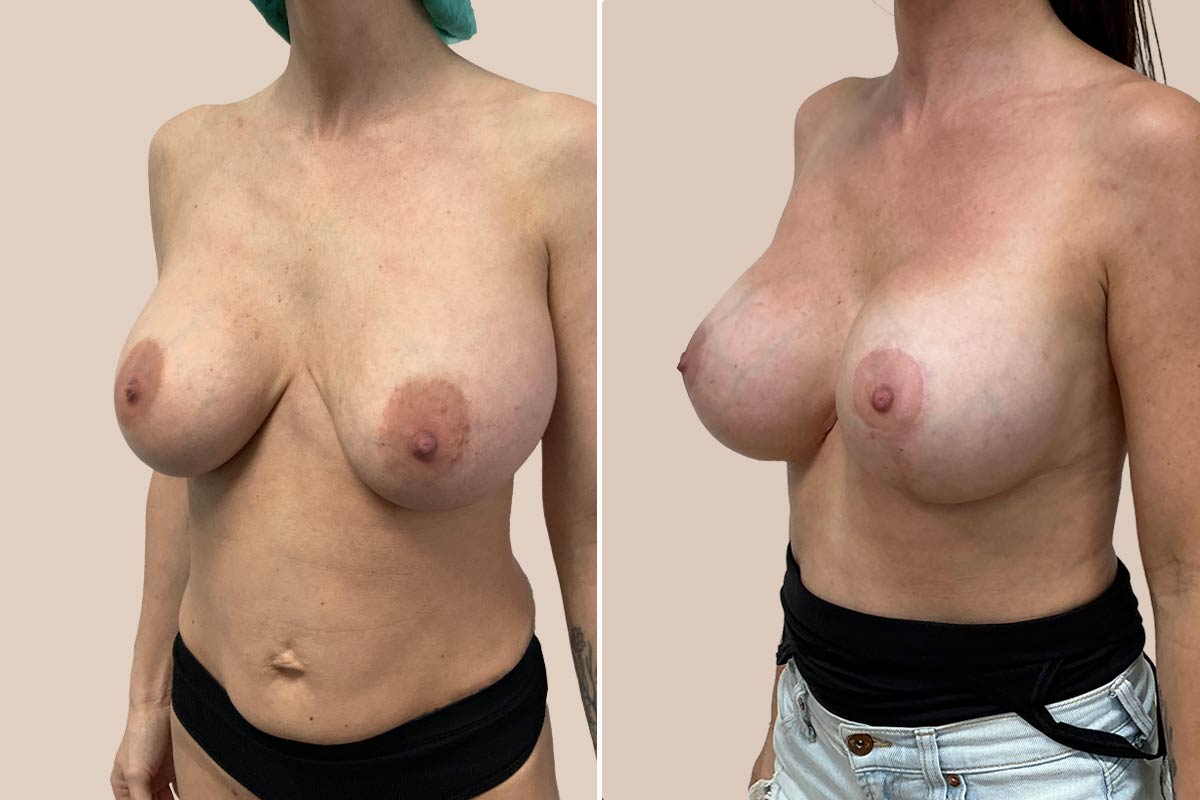 Før og efter udskiftning af implantater