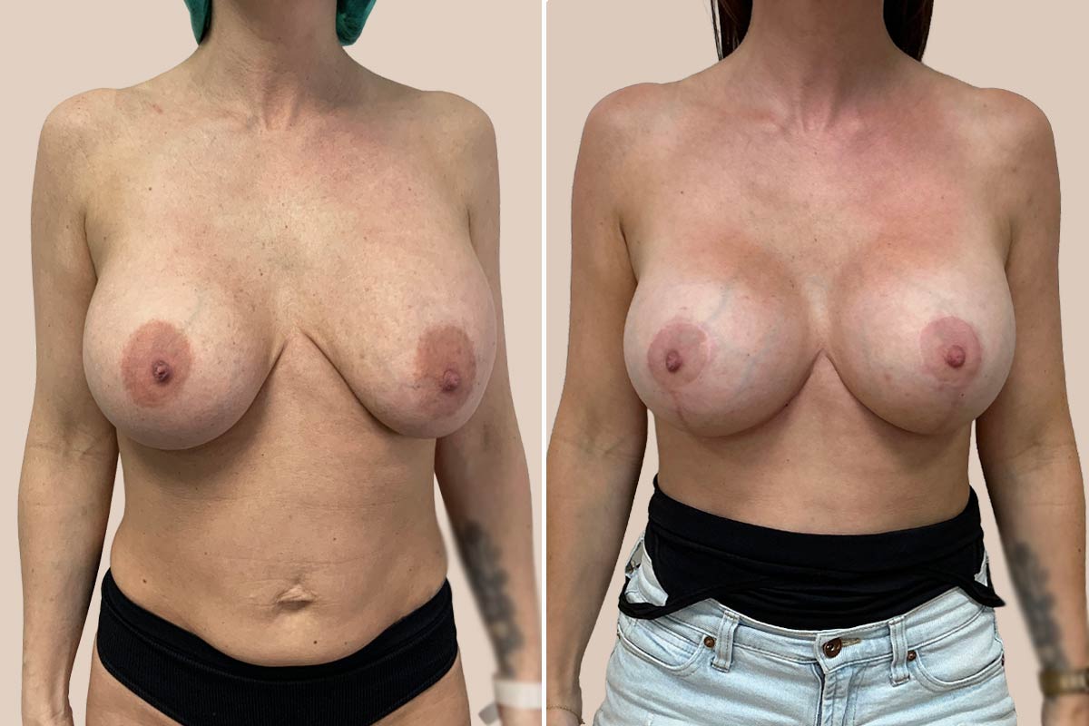 Før og efter udskiftning af implantater