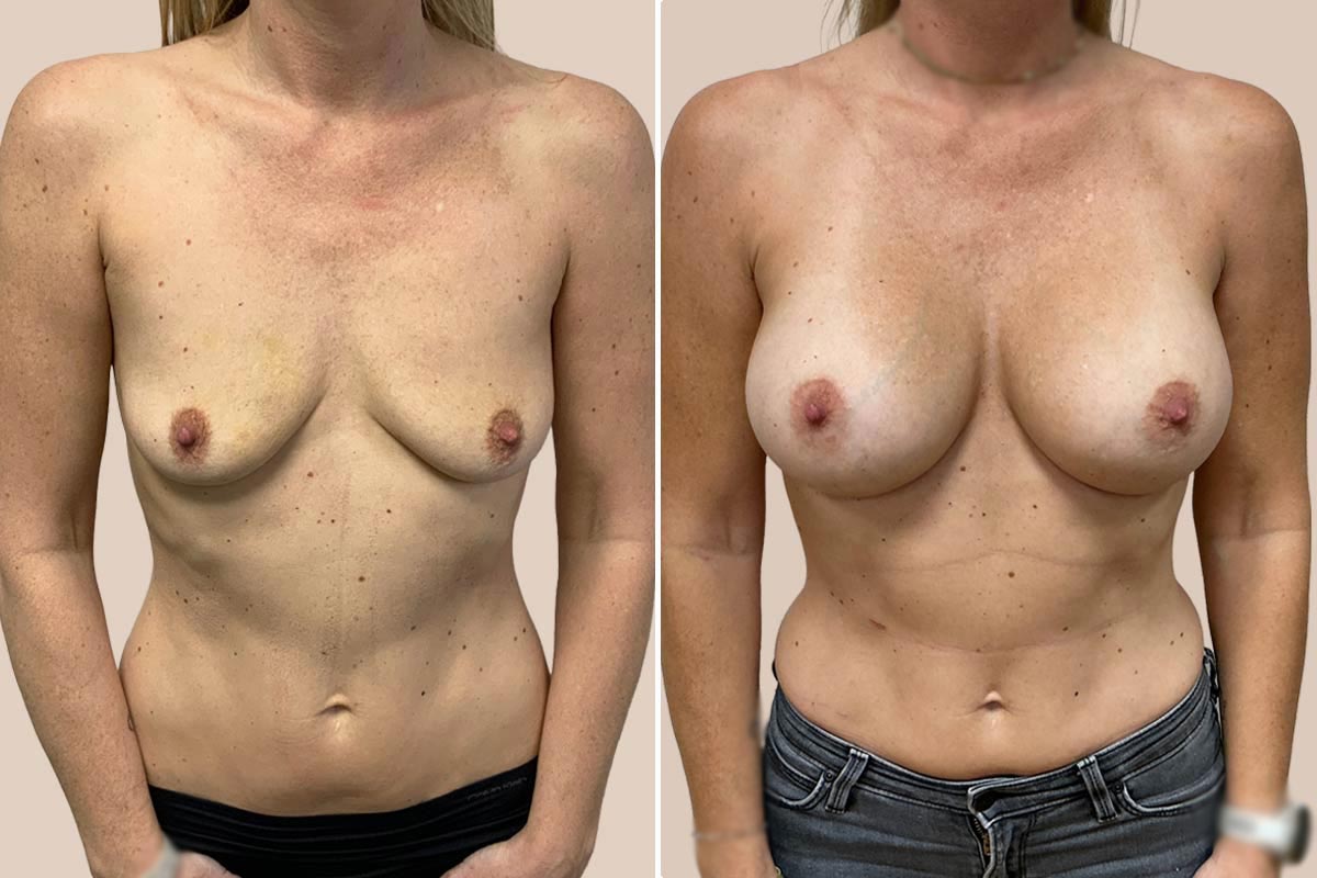 Silimed brystimplantater