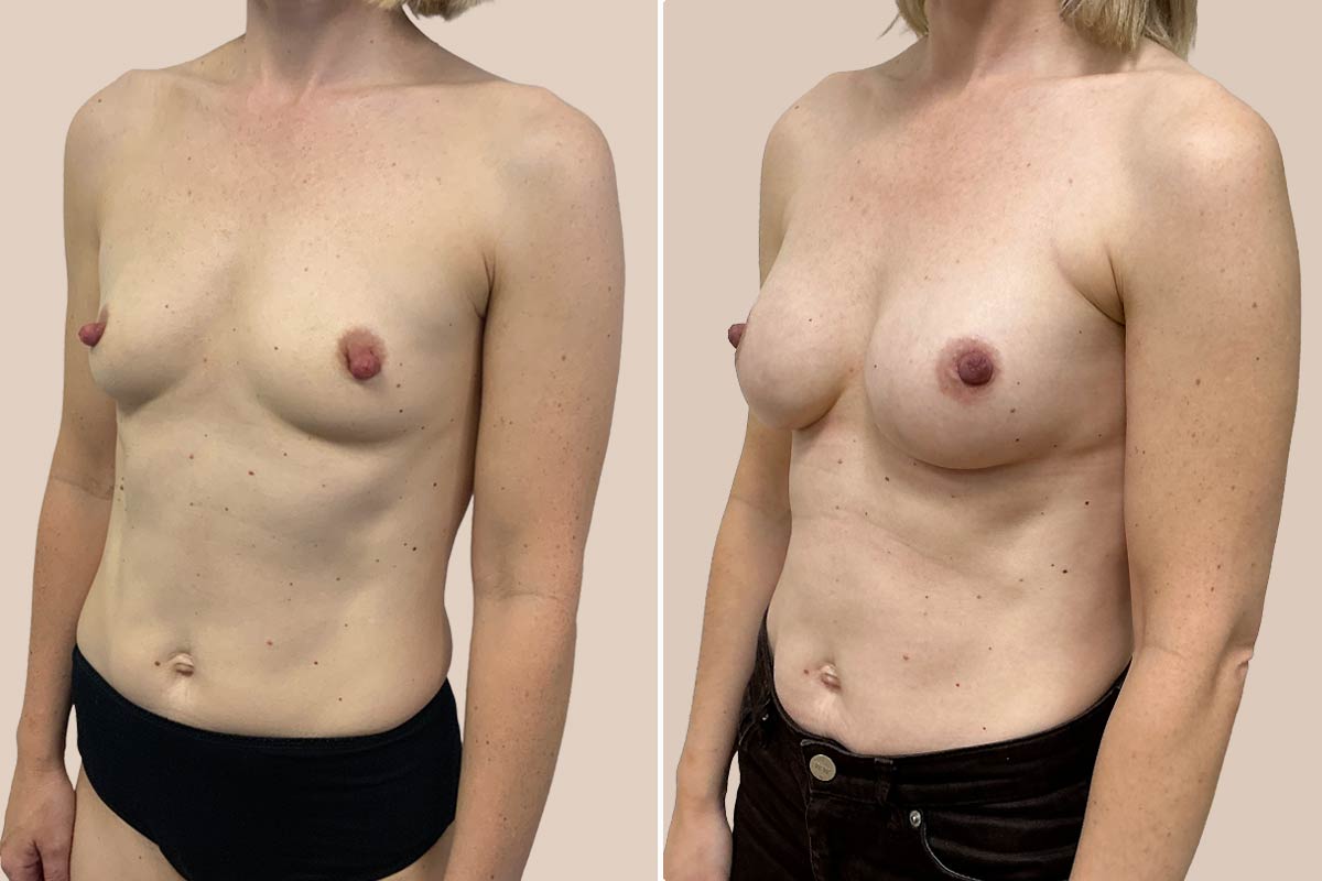 før efter Motiva Preservé brystforstørrelse