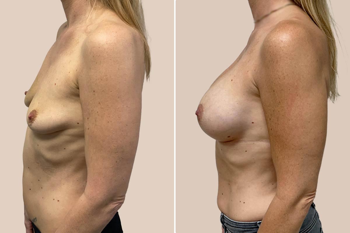 Silimed brystimplantater