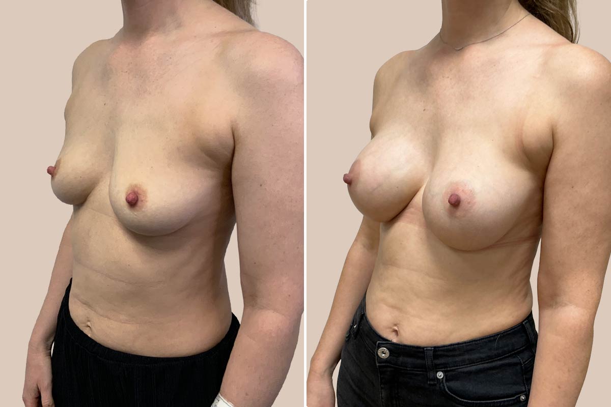 Motiva Preservé før og efter