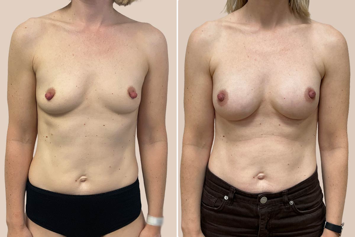 før efter Motiva Preservé brystforstørrelse