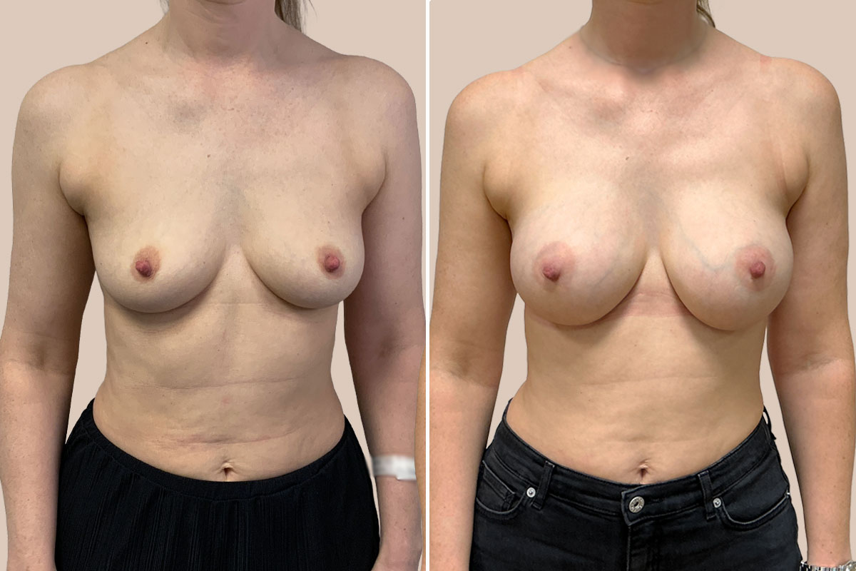 Motiva Preserve før og efter