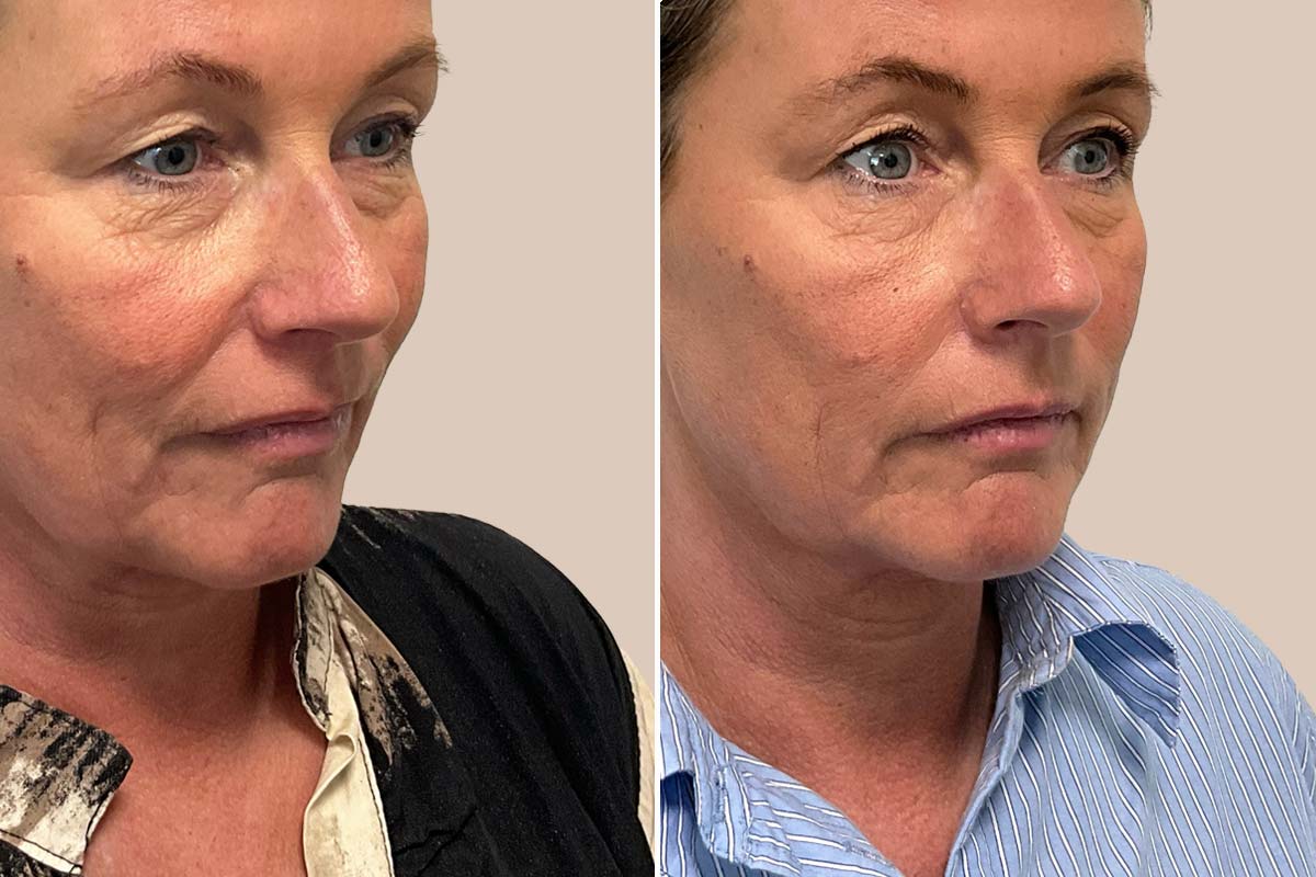 Sunekos injektionsbehandlinger