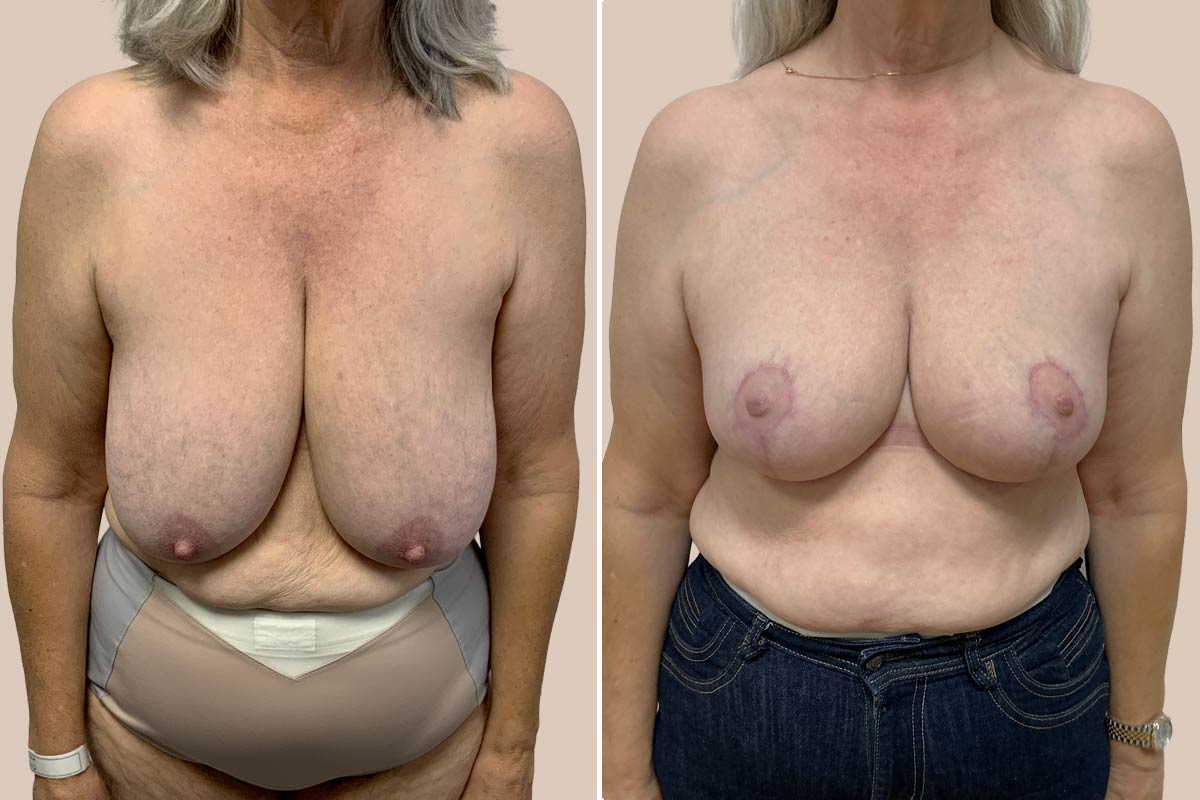 Brystreduktion før og efter