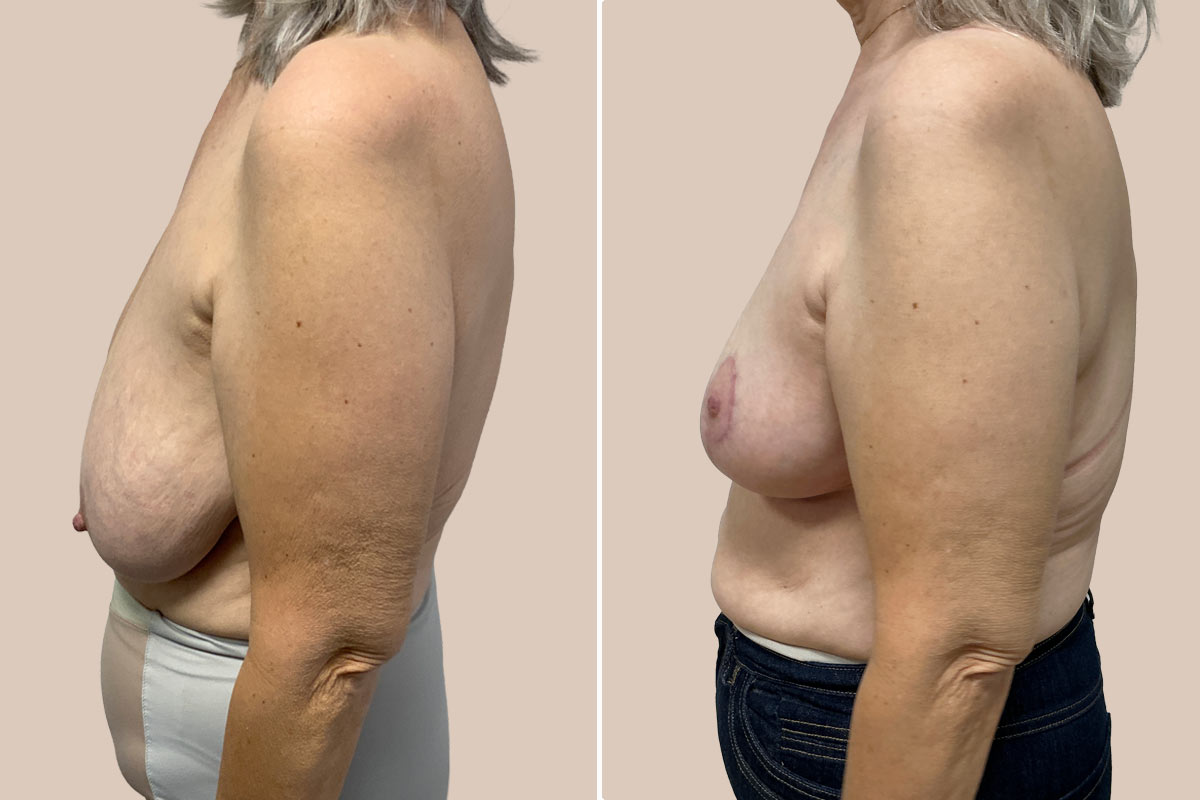 Brystreduktion før og efter