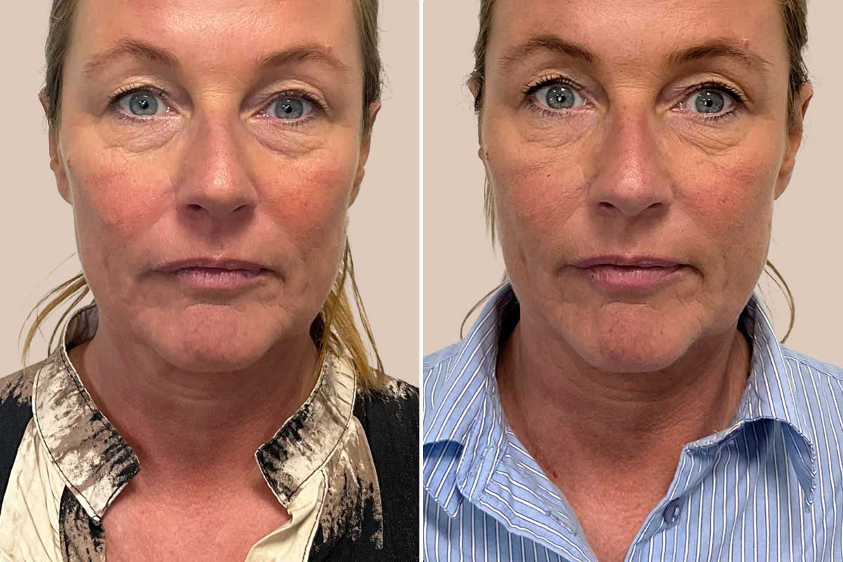 Sunekos injektionsbehandlinger