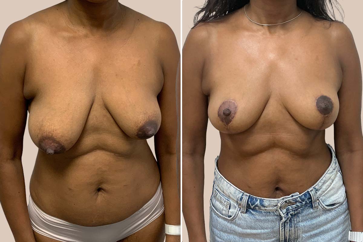 Stort brystløft før og efter