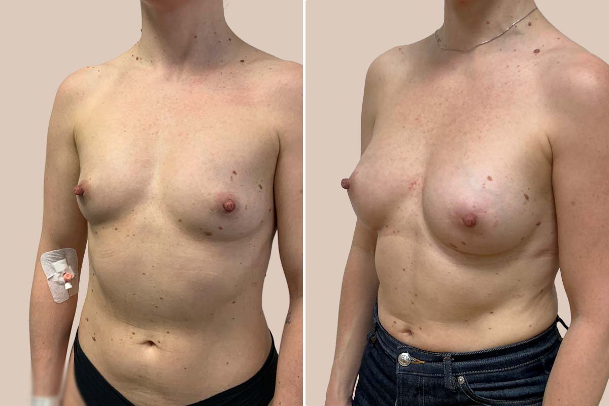 Før efter Preservé brystforstørrelse