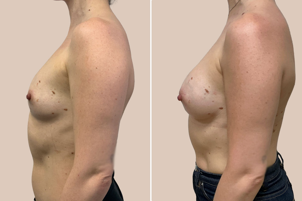 Før efter Preservé brystforstørrelse