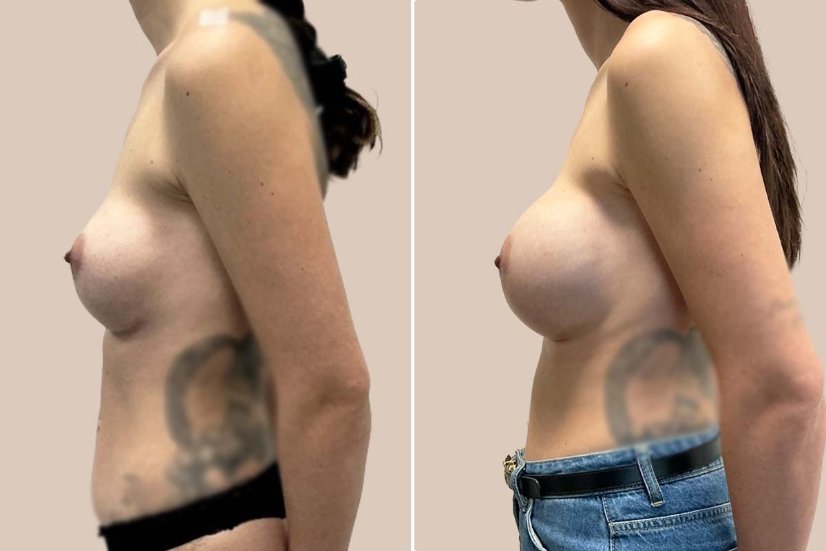 Udskiftning af implantater før og efter