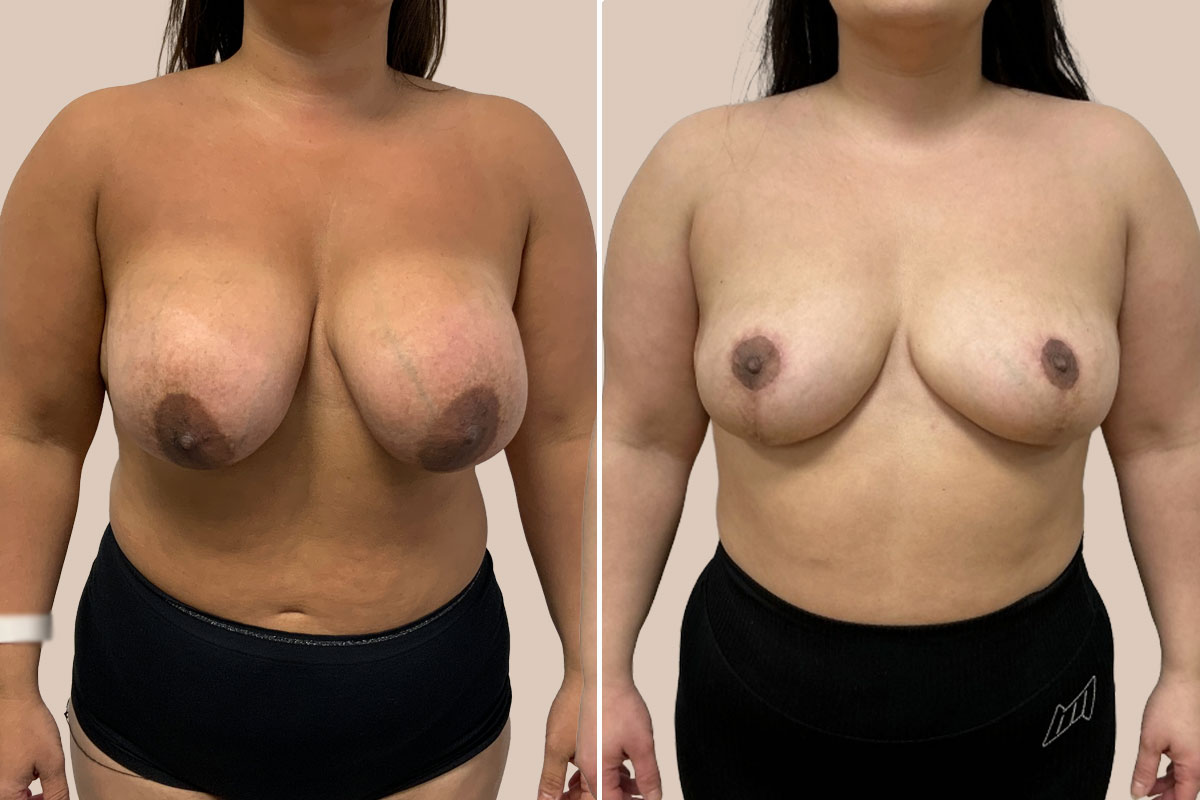 Fjernelse af implantater før og efter