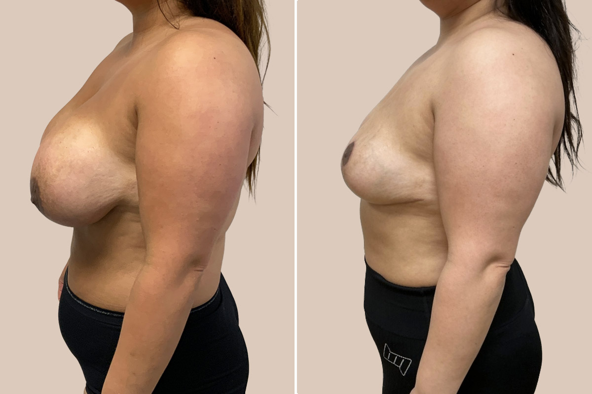 Fjernelse af implantater før og efter