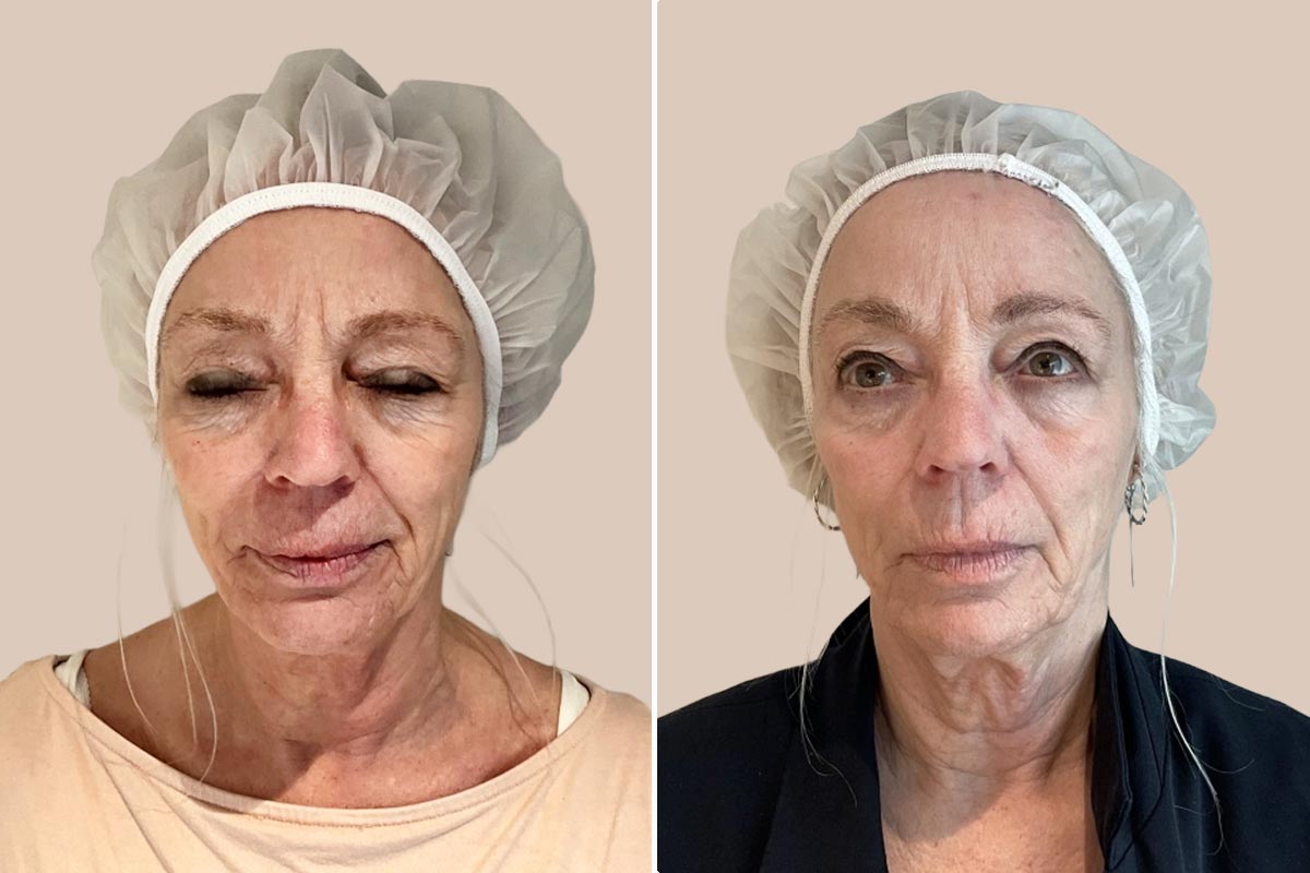 ADVATX laserbehandling