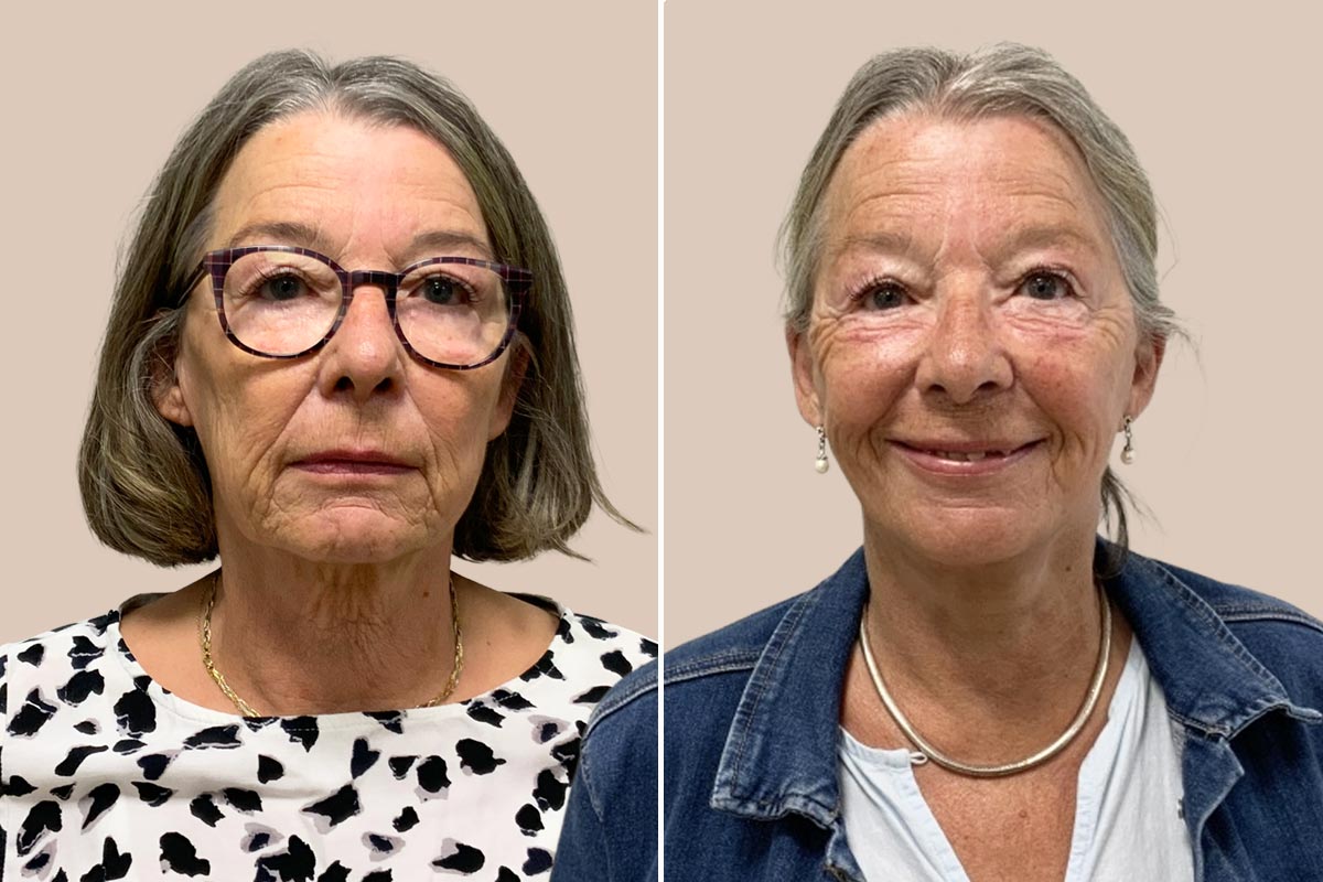 Udvidet halsløft før og efter