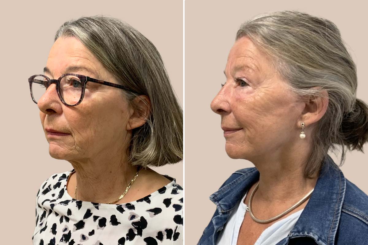 Udvidet halsløft før og efter