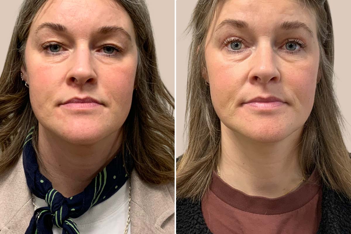 Øjenlågsoperation før og efter