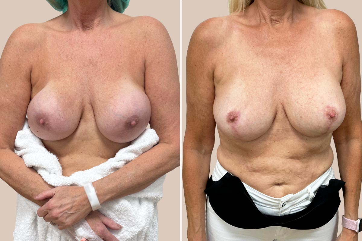 udskiftning af implantater før og efter