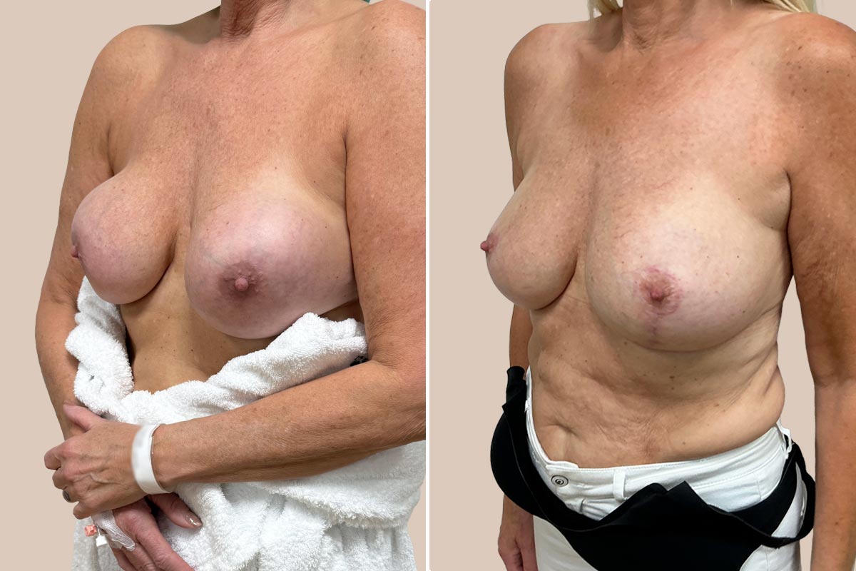 udskiftning af implantater før og efter