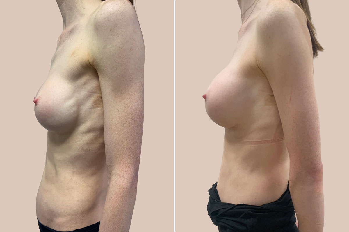 Silimed implantater før og efter
