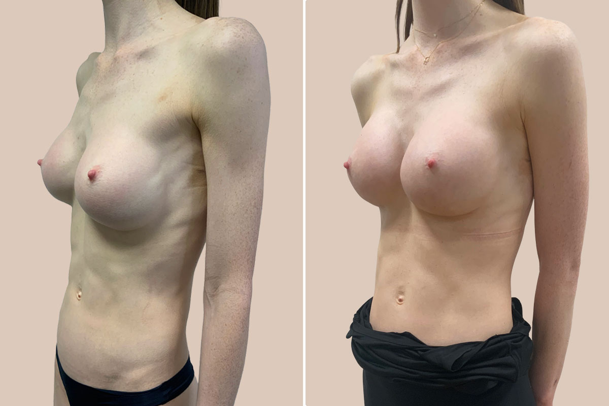 Silimed implantater før og efter