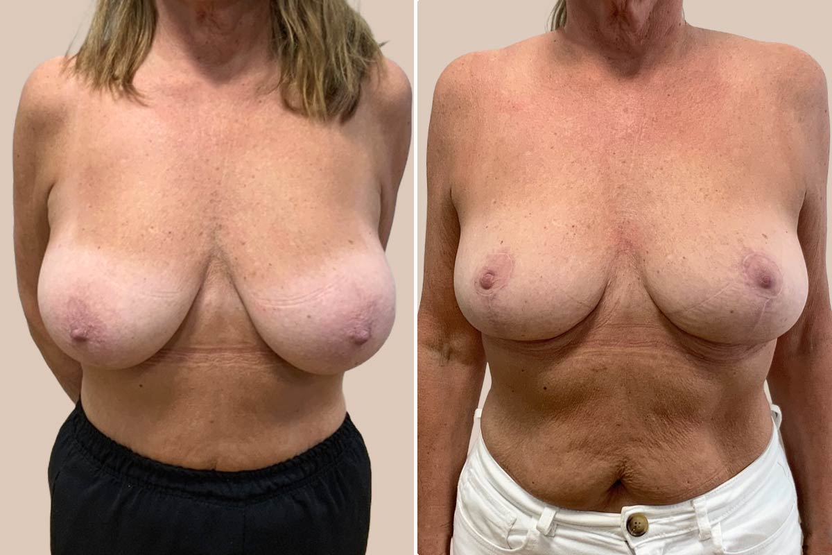 Brystreduktion før og efter